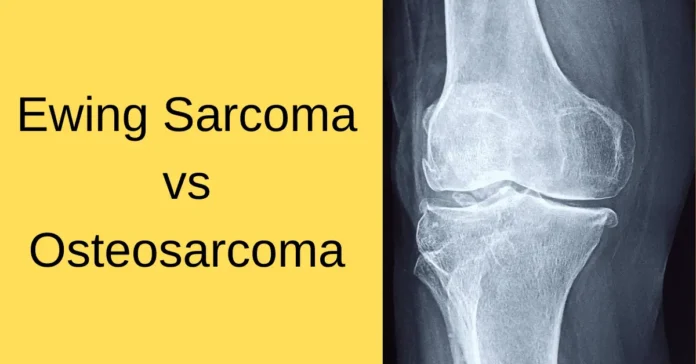 Ewing Sarcoma vs Osteosarcoma