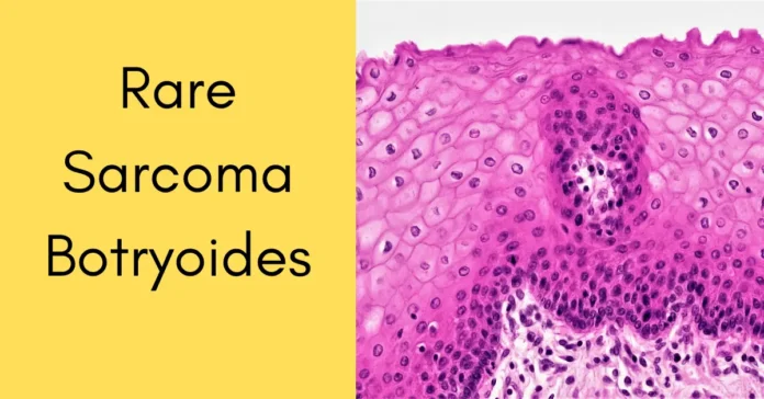 Sarcoma Botryoides