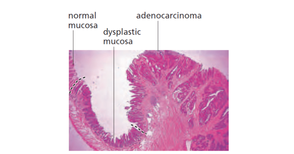 Cancer Cells vs Normal Cells Under Microscope