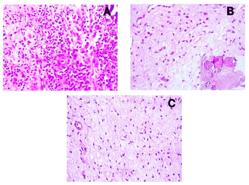 Composite H&E-stained histology image showing three panels (A, B, C) illustrating inflammation and infection patterns: (A) dense inflammatory infiltrate with numerous immune cells, (B) reduced cellularity with scattered cells in a pale stromal background, and (C) relatively normal or mildly affected tissue with sparse cells and preserved architecture.