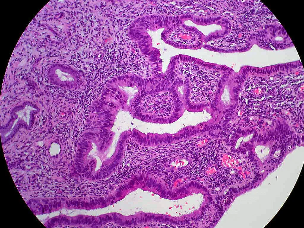 H&E-stained histopathology image of a cervical biopsy showing glandular epithelial proliferation with crowded, irregular glands and enlarged hyperchromatic nuclei, consistent with adenocarcinoma in situ.