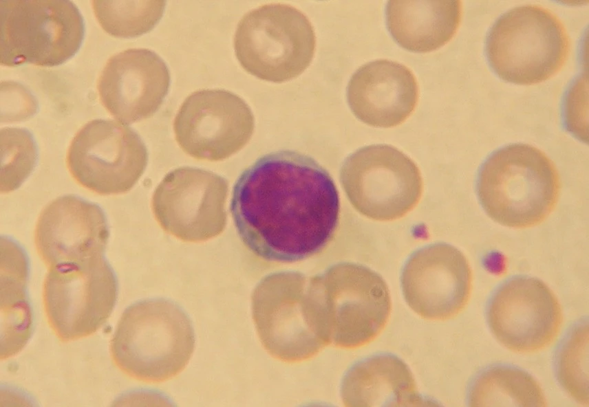 Microscopic image of a peripheral blood smear showing a lymphocyte with a large, dark purple nucleus and thin rim of cytoplasm, surrounded by pale red blood cells.