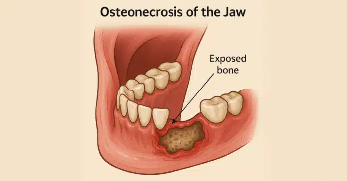osteonecrosis of the jaw