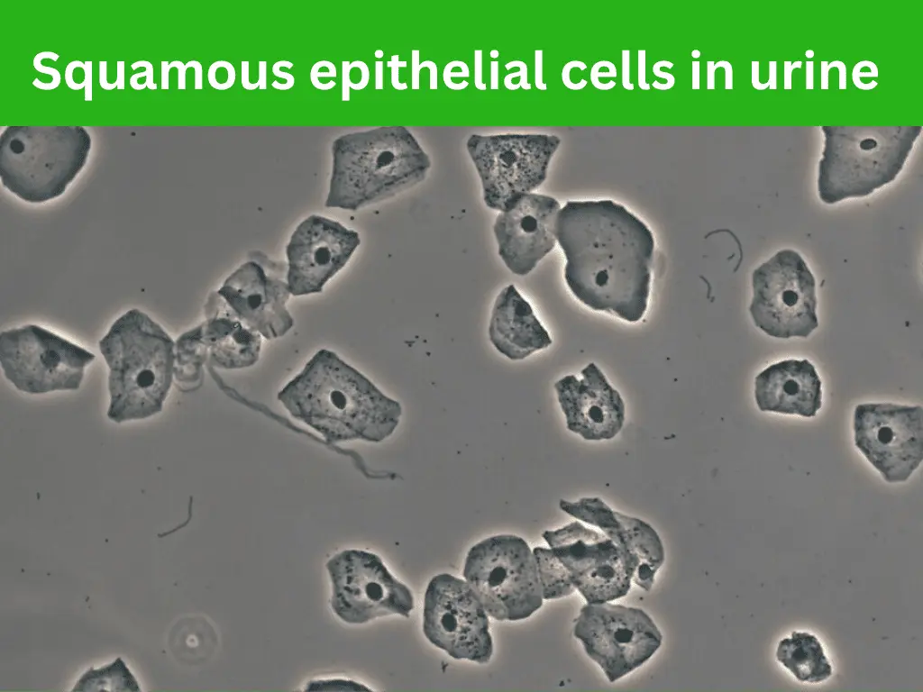 Microscopic view of squamous epithelial cells in urine, showing large, flat, irregularly shaped cells with distinct central nuclei scattered across the field.