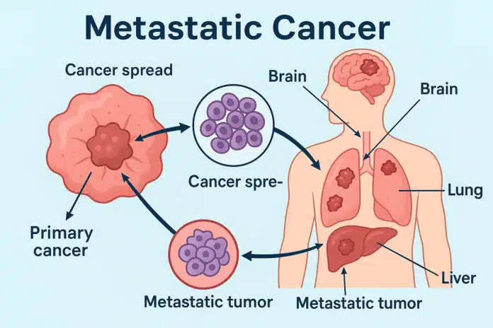 Metastatic cancer