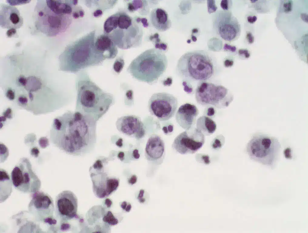 Urine citology, PAP 400x. Severe urothelial atypia (urothelial carcinoma)