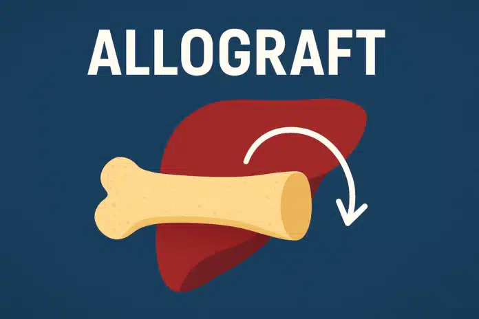 Allograft Definition, Allograft vs autograft, and Rejection