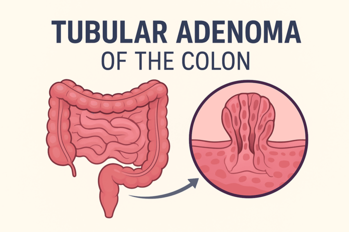 Tubular Adenoma of the Colon