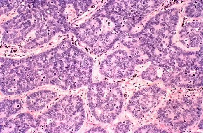Neuroendocrine carcinoma
